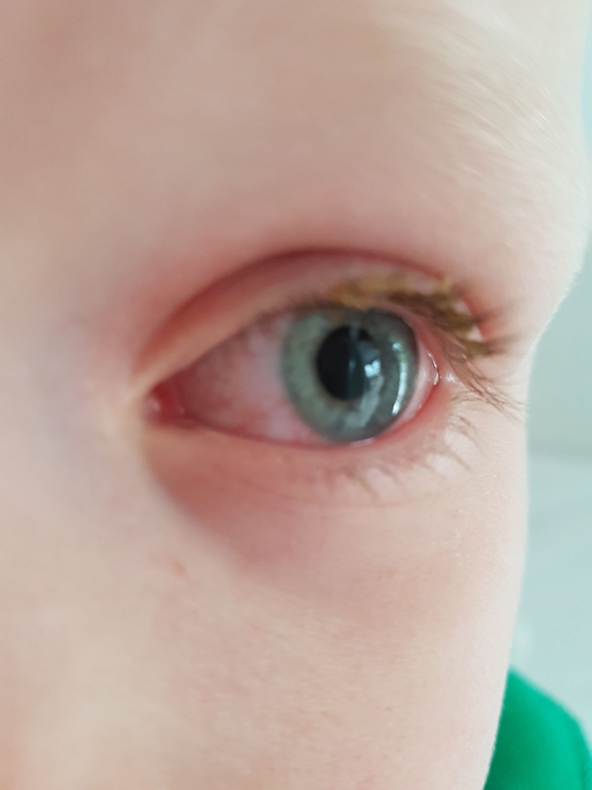 Bindehautentzündung, was können Sie dagegen tun? Kinderblog Bindehautentzündung, was können Sie dagegen tun? Kinderblog